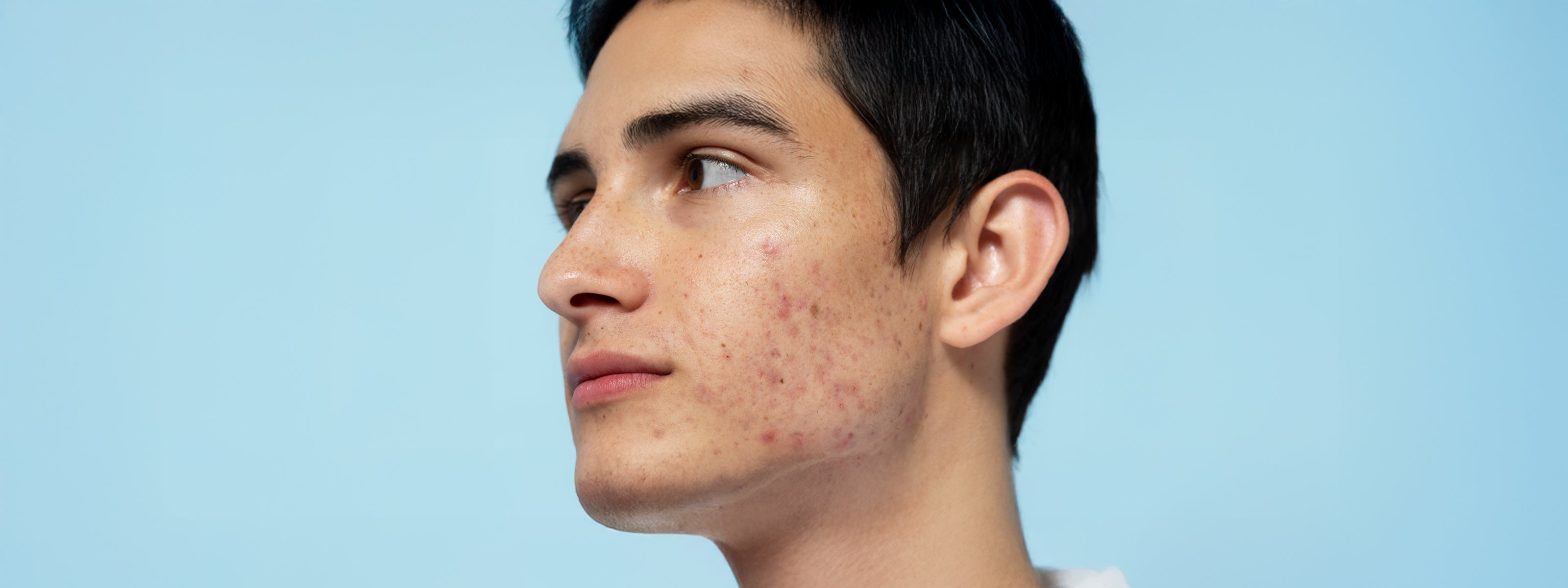 10 Holistic Approaches to Acne Treatment: Integrating Traditional and Alternative Therapies