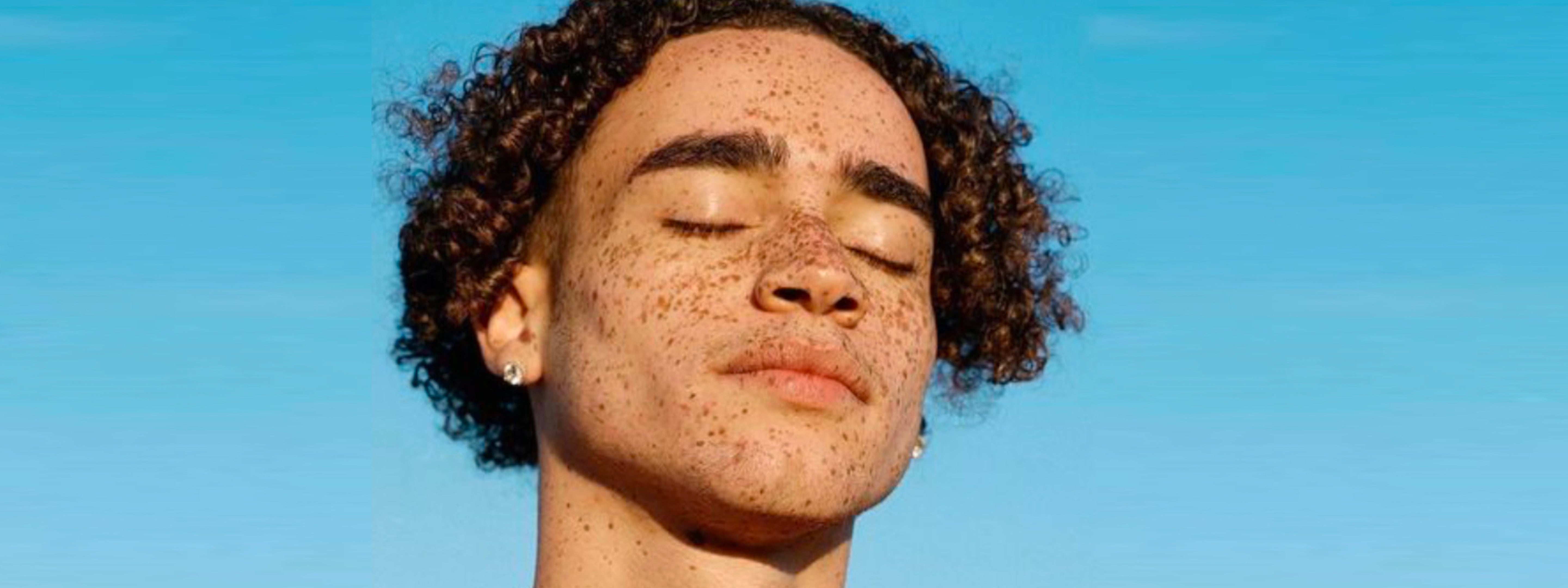Hyperpigmentation vs Melasma: Causes & Treatments