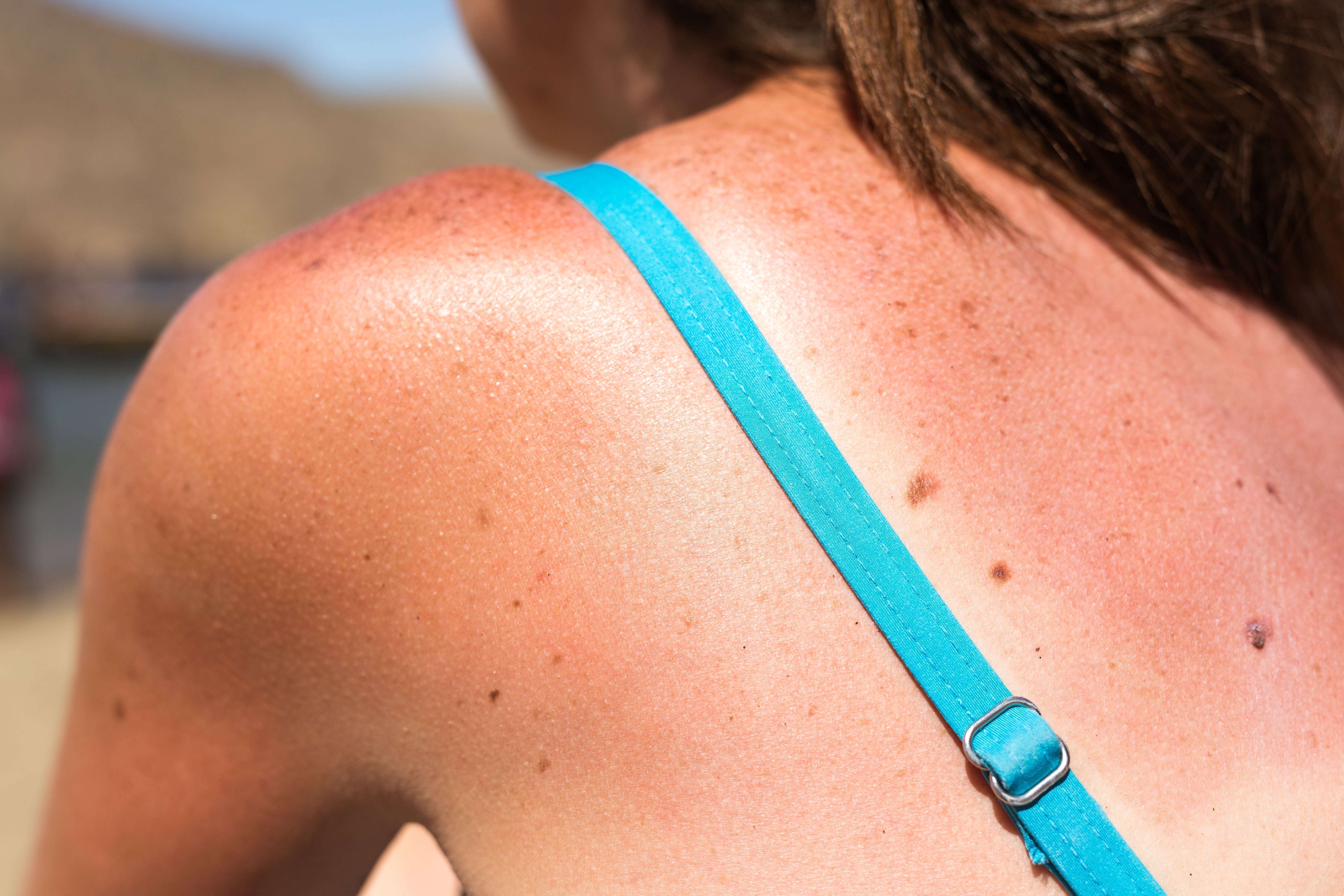 Why SPF Is Non-Negotiable for Every Skin Type