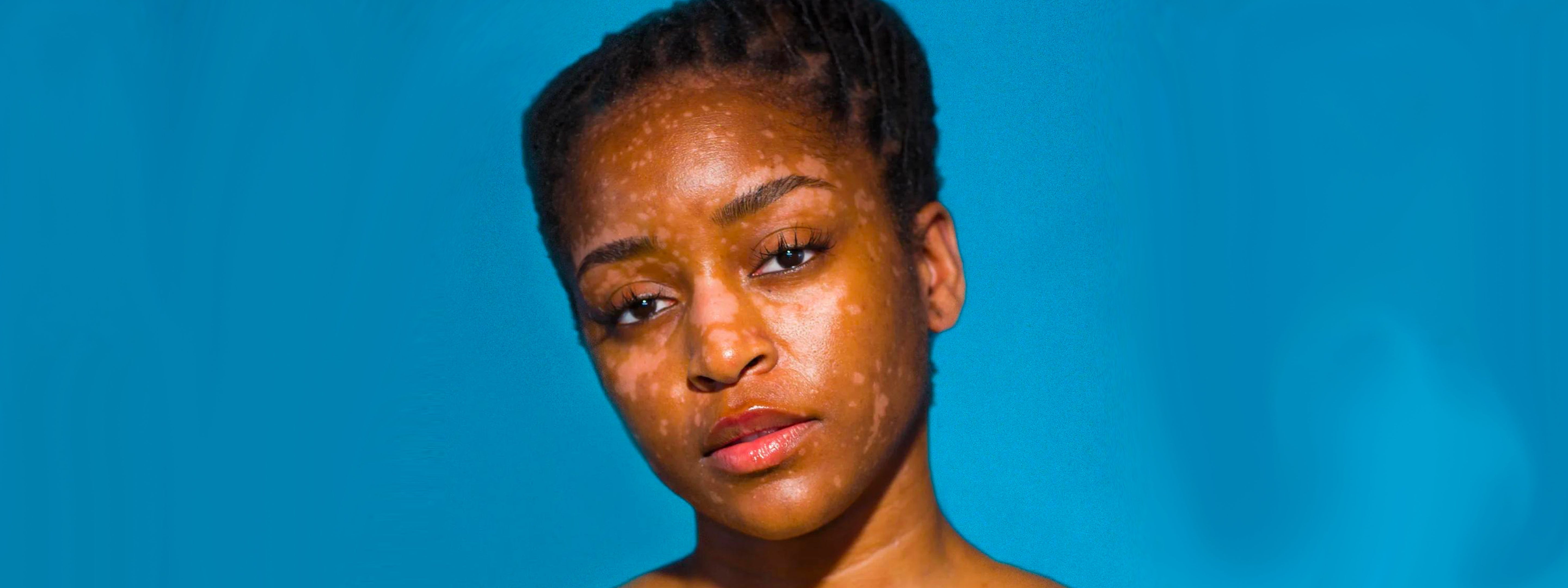 Psoriasis & SPF: The Do's & Don'ts